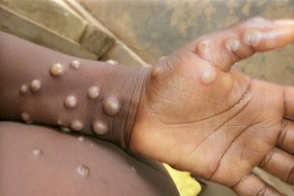 Estudo mostra novas características das lesões da varíola dos macacos