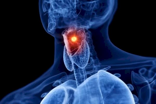 Câncer de laringe: saiba quais são os sintomas e fatores de risco