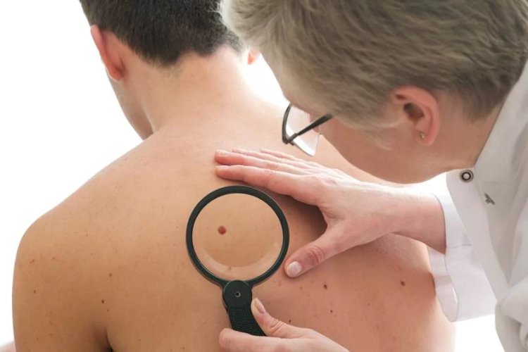 Dezembro Laranja: confira os sinais mais comuns do câncer de pele