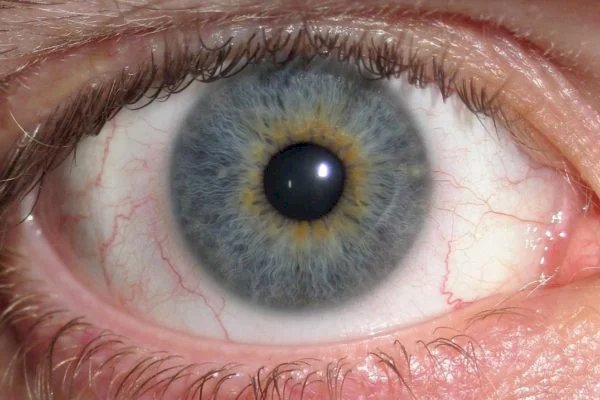 Sinal no olho pode indicar colesterol alto. Entenda