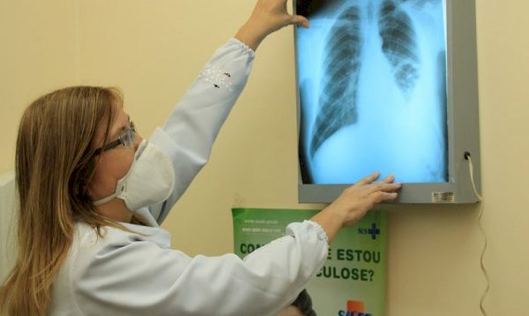 Brasil instala comitê interministerial para eliminação da tuberculose
